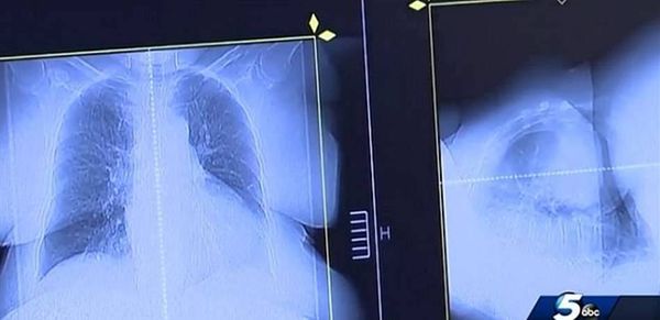 توقع الأطباء وفاته في غضون 3 أشهر.. فعالج نفسه من السرطان بدواء للكلاب!