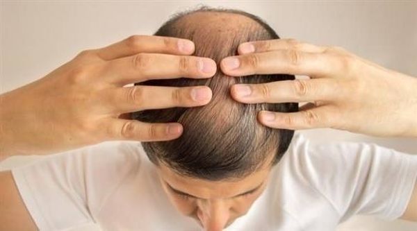 هل توجد علاجات فعّالة للصلع عند الرجال؟