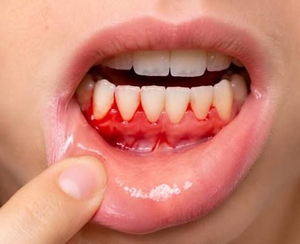 ما العلاقة بين نزيف اللثة والخرف؟