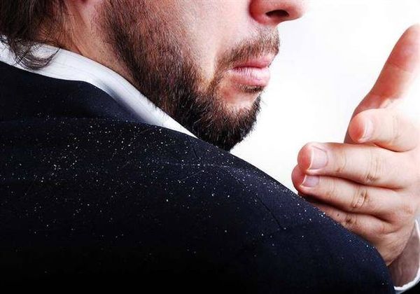 في هذه الحالة فقط تصبح الشامبوهات ضد القشرة غير مجدية!