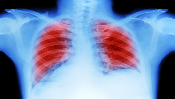 سرطان الرئة: علامة "العلم الأحمر" التي تظهر عند السعال!