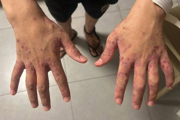 مكتب إعلام الأسرى يحذر من تفاقم انتشار الجرب في سجن النقب