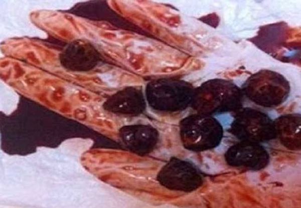 لن تصدق ما تم استخراجه من بطن طفلة؟!