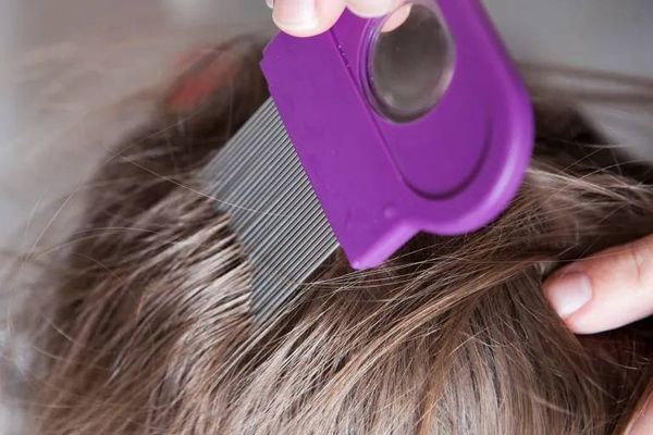 العلامات التي تكشف الإصابة بفطريات فروة الرأس