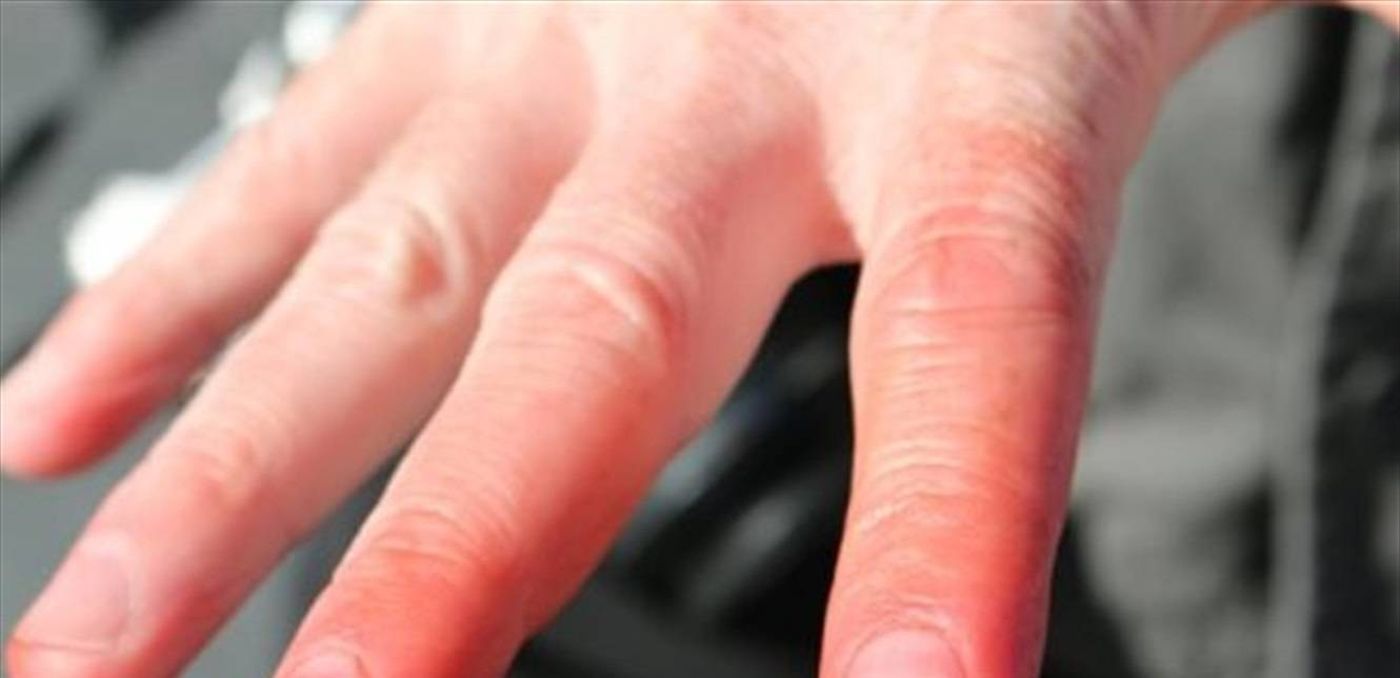 ما هو تثليج الأطراف؟ إليكم أعراضه وأسبابه وعلاجه