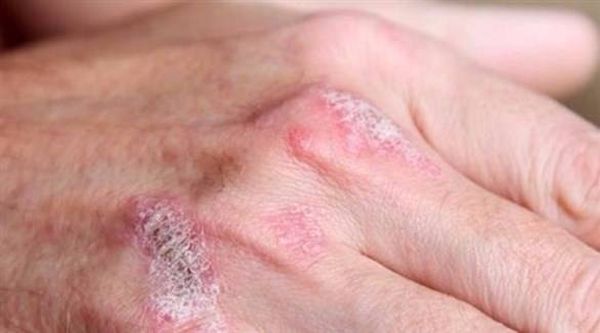 الماء والملح ساعة يومياً يخلصك من الصدفية!