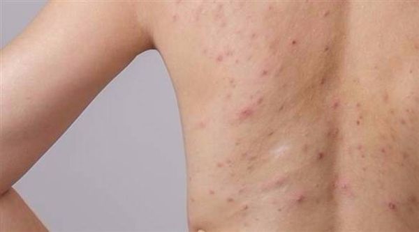 لماذا تظهر بثور على الظهر؟