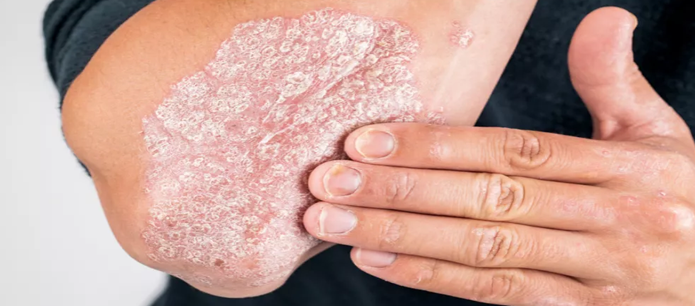 الأطعمة النباتية قد تقلل أعراض الصدفية