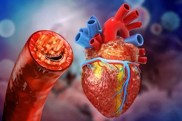 البقع الصفراء حول العين… علامة مبكرة على أمراض القلب؟