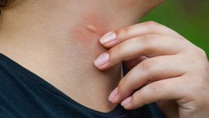 الملاريا... مرض عالمي ويطرق أبواب لبنان... لا خطر وبائيا ولكن الحذر واجب