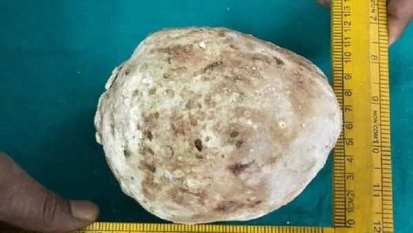 بالصور.. استخرجوا حجر وزنه 1.36 كلغ من جسمه!