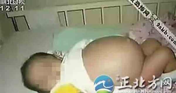 لن تصدق..رضيع يلد شقيقه التوأم من بطنه!