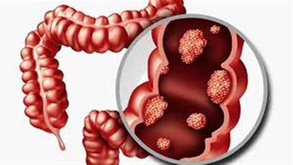اكتشاف مذهل: دور بكتيريا الأمعاء في نشوء سرطان المثانة!