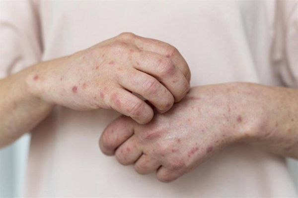 رابط بين «جدري القردة» وحالة خطرة تصيب الدماغ !!