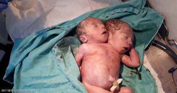 بالصور.. حالة نادرة لولادة طفل سوري "برأسين"