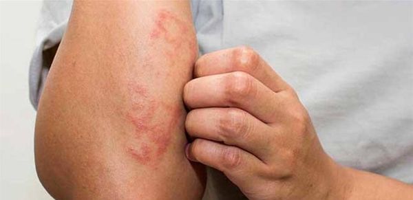 مصاب بها ربع أطفال الكويت... هل "الأكزيما" معدية؟
