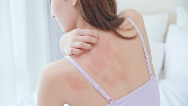 دراسة بريطانية تكتشف ارتباط أمراض الجلد بمشكلات الصحة العقلية