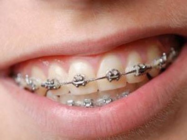 احذر.. التقويم يسبب أضرارا وخيمة باللثة .. تعرف عليها!