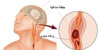 الجلطة الدماغية: 4 حيل تُنقذ حياتك وحياة غيرك۔۔۔ تعرف عليها!