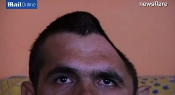 بالفيديو – فقد نصف رأسه وبقي على قيد الحياة!