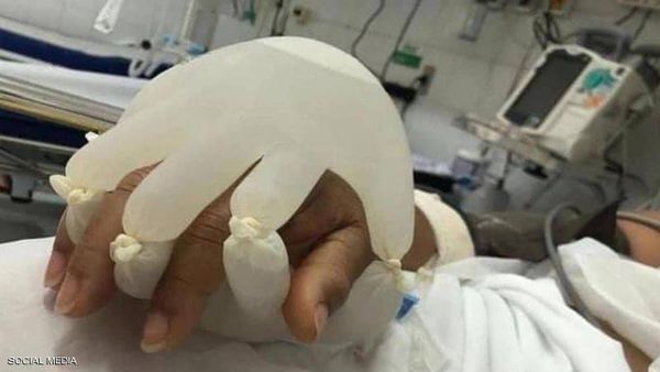 ممرضة تدعم مرضى كورونا بـ"قفاز ماء دافئ"