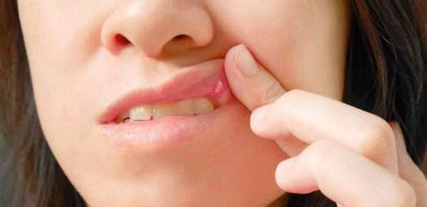 علاج التهاب الفم باستخدام الأدوية