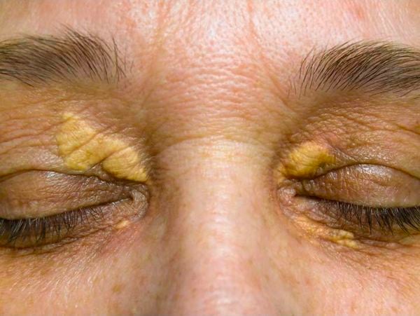 علامات على الوجه قد تنذر بارتفاع الكوليسترول