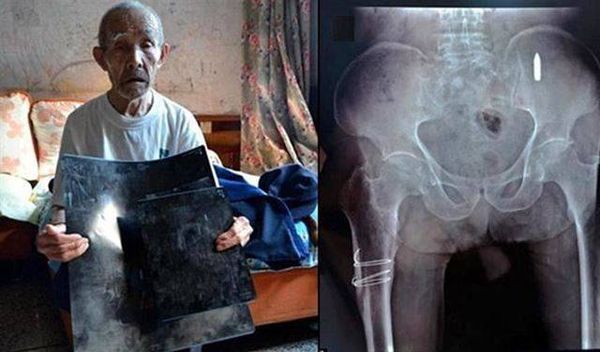 صيني "ليس لديه أي فكرة" عن رصاصة في جسده منذ 70 عاما
