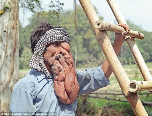 بالصورة-ورم كبير في وجهه جعل منه 