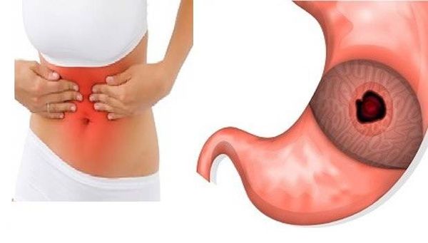 الأعراض ال 8 الأهم لقرحة المعدة ( وكيف نعالجها طبيعياً )