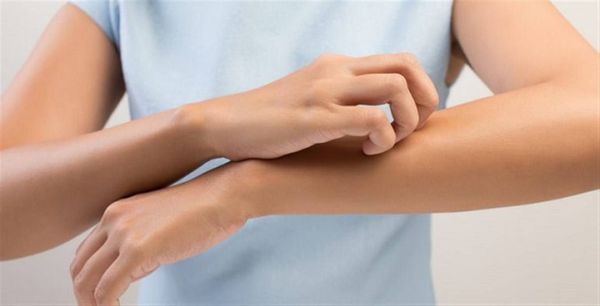 الخبر الصادم:الإكزيما قد تكون إشارة لأمراضٍ في القلب؟