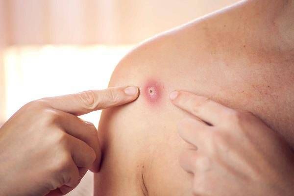 ارتفاع كبير عالمياً في أعداد الإصابة بجدري القردة