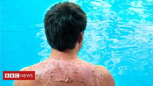Heatwave sunburn: 220 people treated in NI hospitals