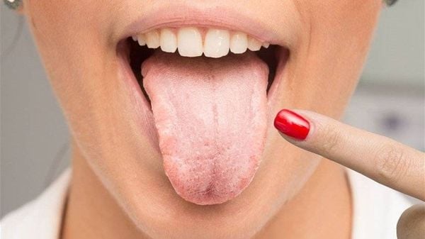 تغيّر لون اللسان.. على ماذا يدل؟