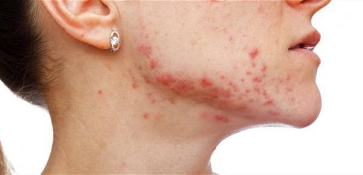 حب الشباب المزعج يظهر على رقبتك.. كيف تتصرفين حياله؟