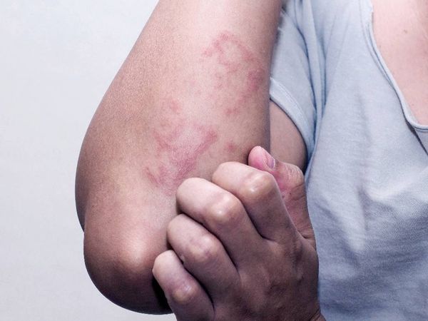 لتقليل الالتهابات... إليك نصائح مهمة