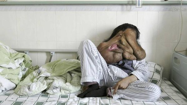 بالصور.. "الرجل الفيل" مصاب بأكبر ورم في العالم