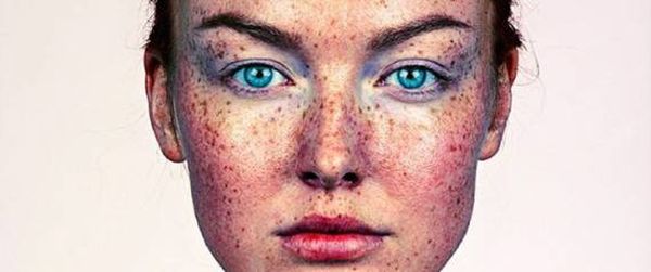 لماذا يظهر النمش؟ وكيف تتخلصين منه بطرق طبيعية؟