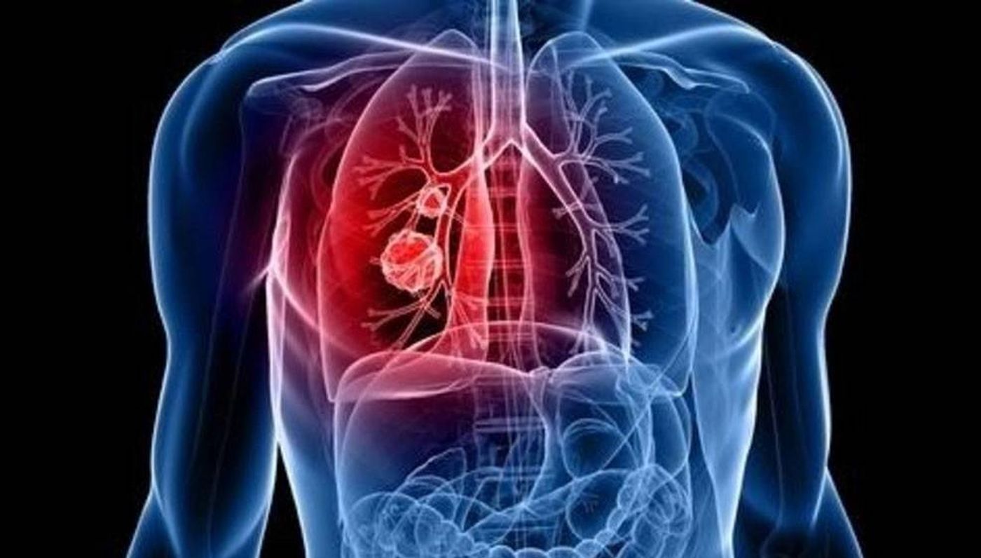 الكشف عن سبب مقاومة بعض خلايا سرطان الرئة الشديد للعلاج