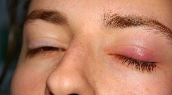 دمل العين.. أسبابه وطرق علاجه