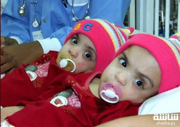 فصلوا جسديهما منذ 11 عاماً… تؤام نجا من جحيم الالتصاق